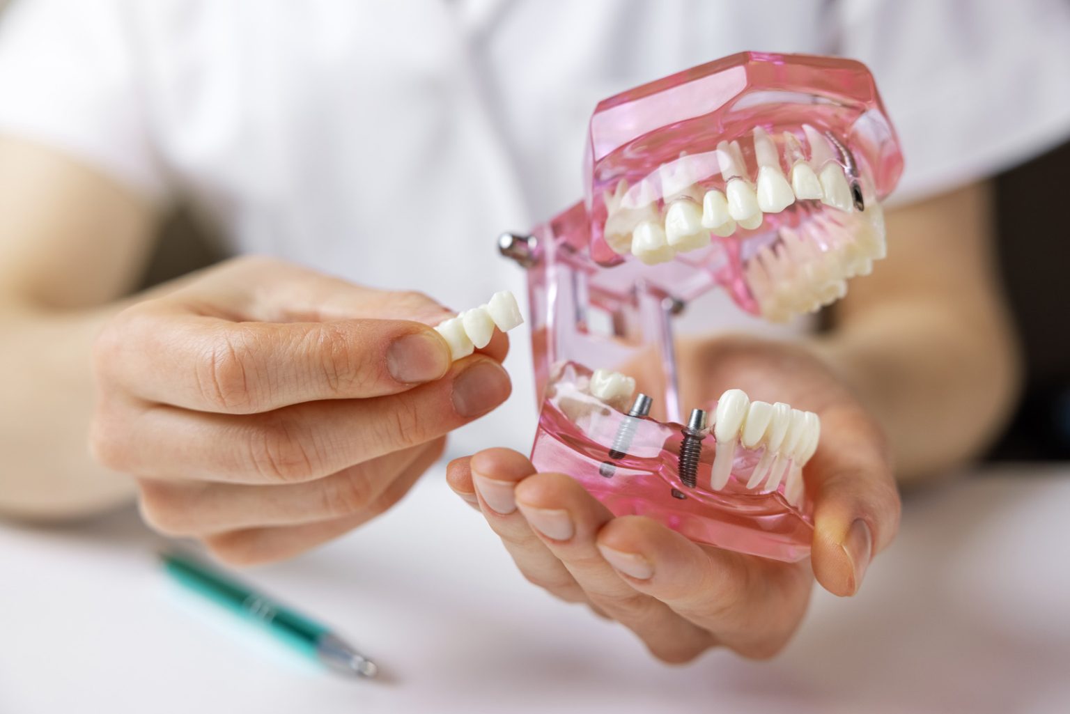 Dental Bridges in Restoring Your Smile and Functionality