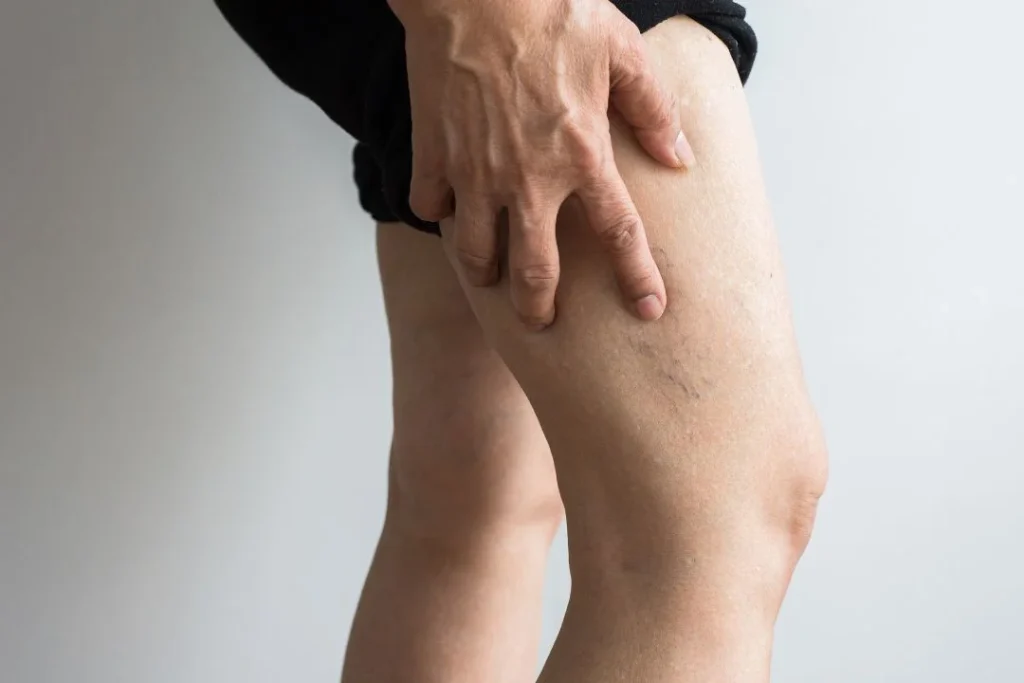 Early Detection for Deep Vein Thrombosis