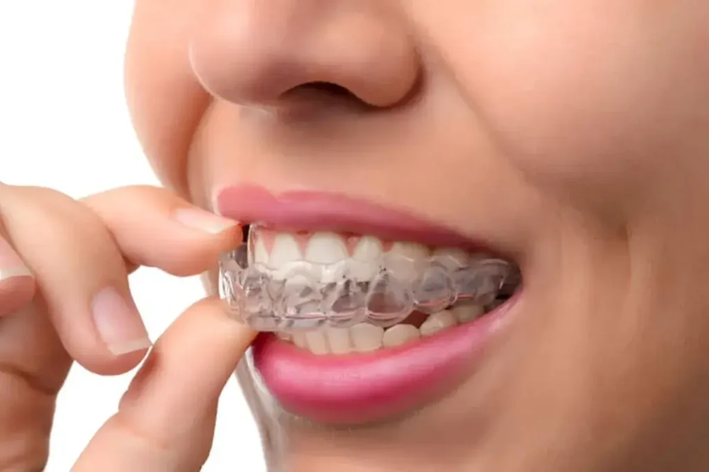 Achieving a Restored Smile with Invisalign Treatment Invisalign Treatment