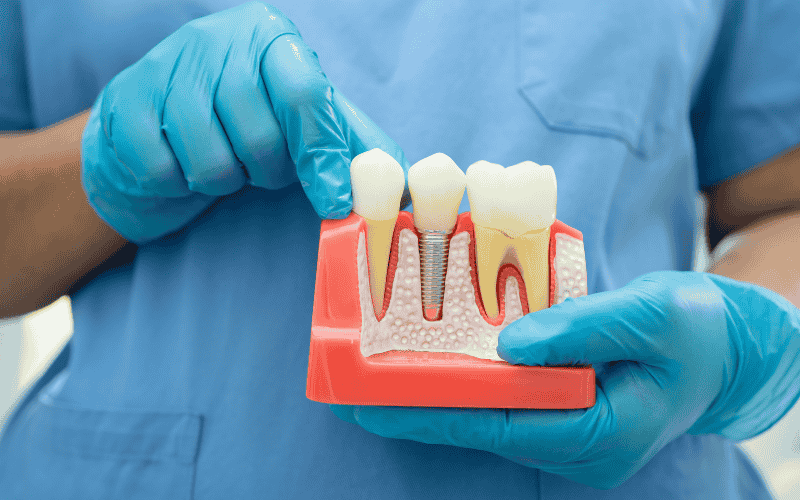 Exploring the Long-term Benefits of Dental Implants Long-term Benefits of Dental Implants