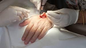 A Step-by-Step Guide to Mohs Surgery Step-by-Step Guide to Mohs Surgery