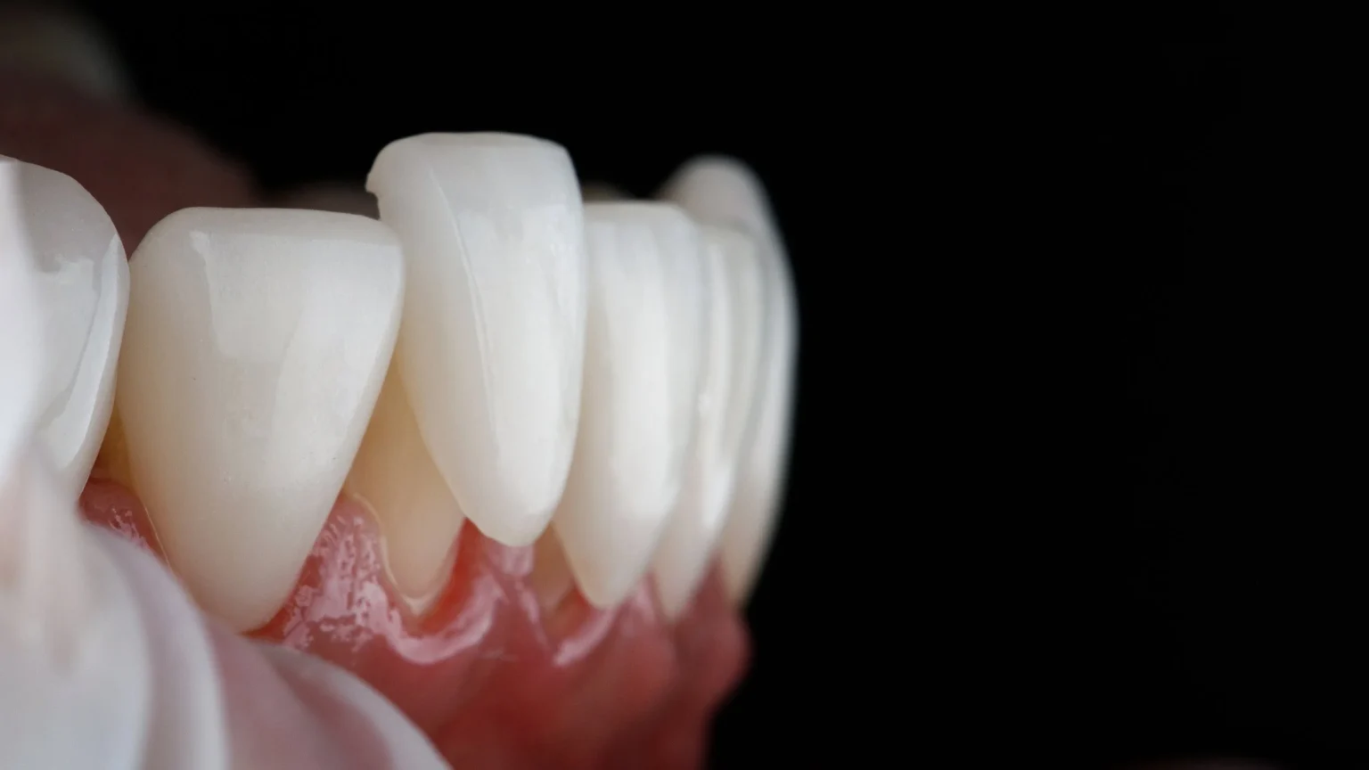 The Process of Getting Dental Veneers Getting Dental Veneers