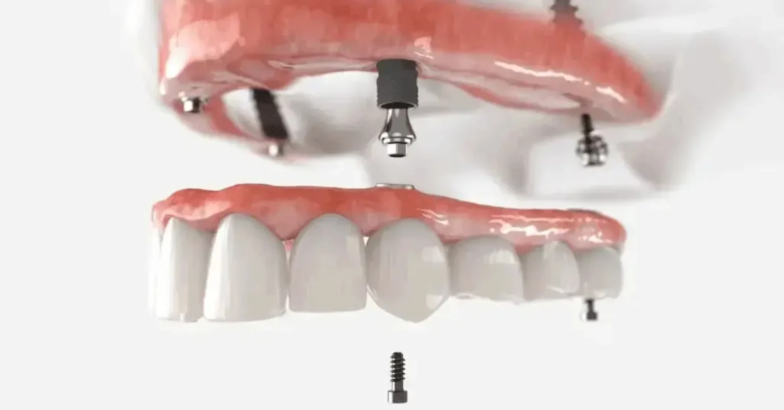 What To Ask Your Dentist About All-In-X Dental Implants All-In-X Dental Implants