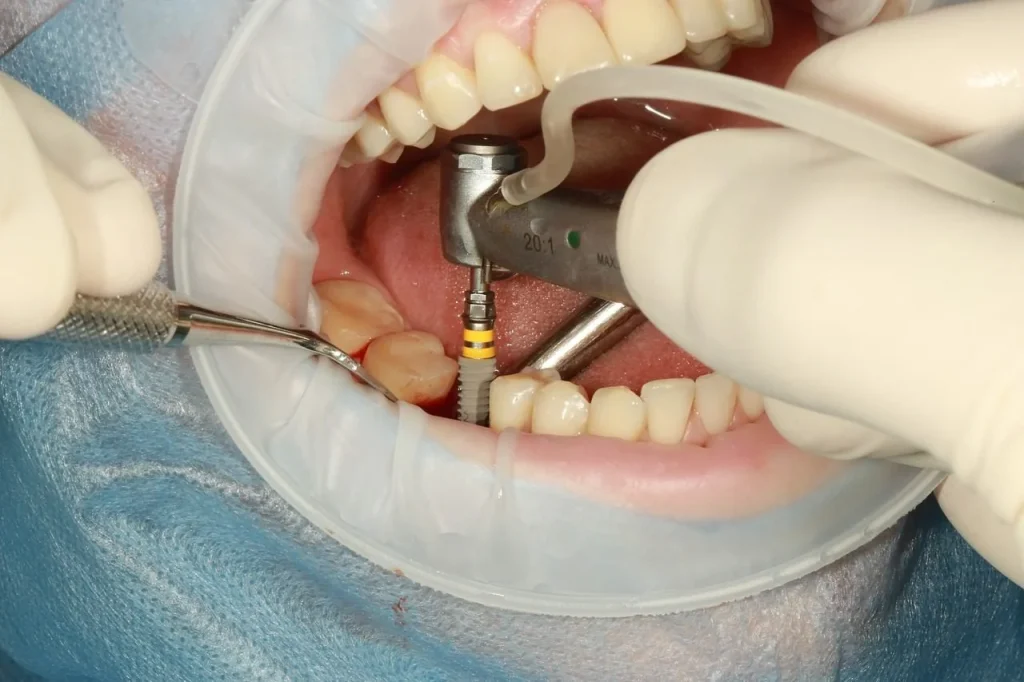 The Process of Getting Dental Implants Getting Dental Implants