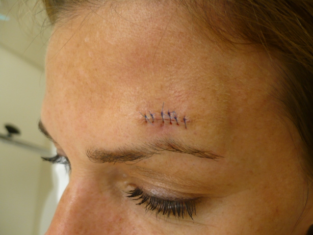 Caring for Your Skin After Mohs Skin Cancer Surgery Mohs Skin Cancer Surgery
